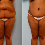Body Lift before and after photos in Houston, TX, Patient 26773