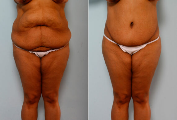 Body Lift before and after photos in Houston, TX, Patient 26773