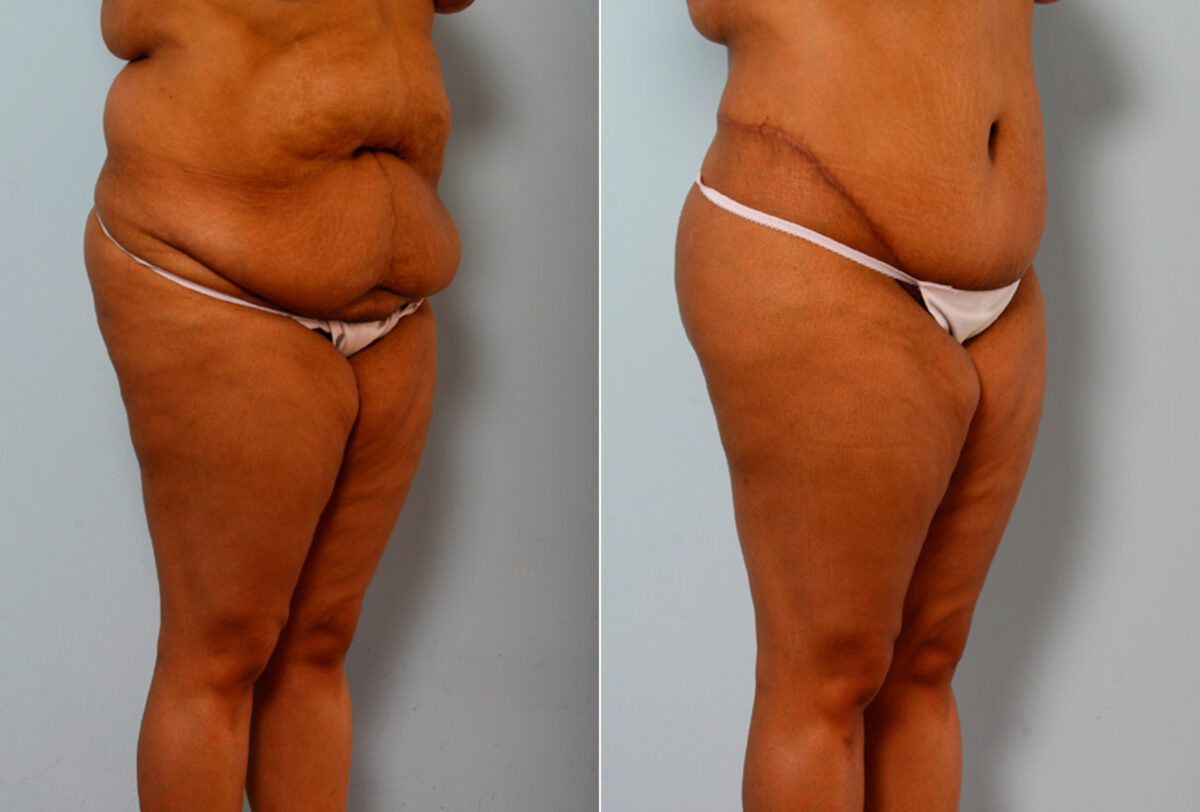 Body Lift before and after photos in Houston, TX, Patient 26773