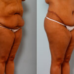 Body Lift before and after photos in Houston, TX, Patient 26773