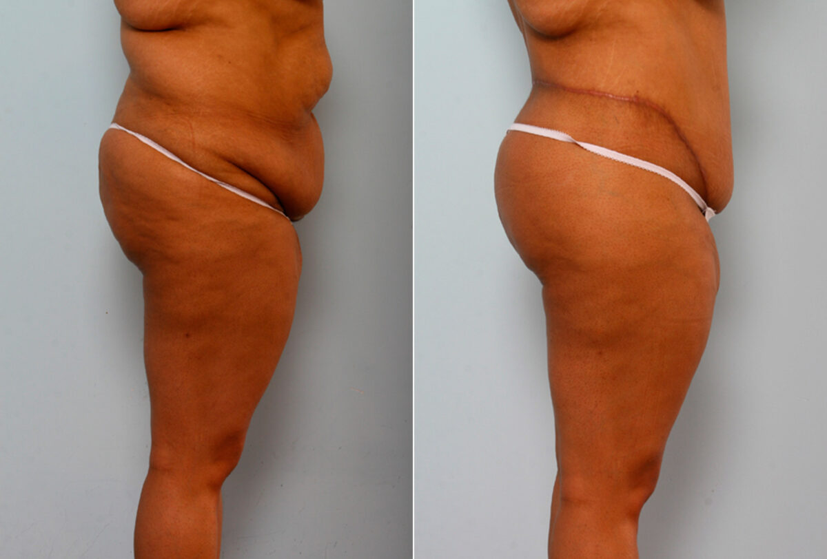 Body Lift before and after photos in Houston, TX, Patient 26773