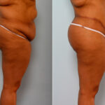 Body Lift before and after photos in Houston, TX, Patient 26773