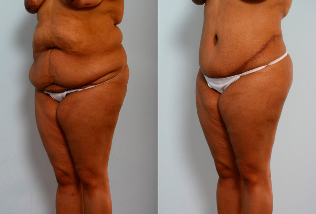 Body Lift before and after photos in Houston, TX, Patient 26773