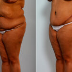 Body Lift before and after photos in Houston, TX, Patient 26773