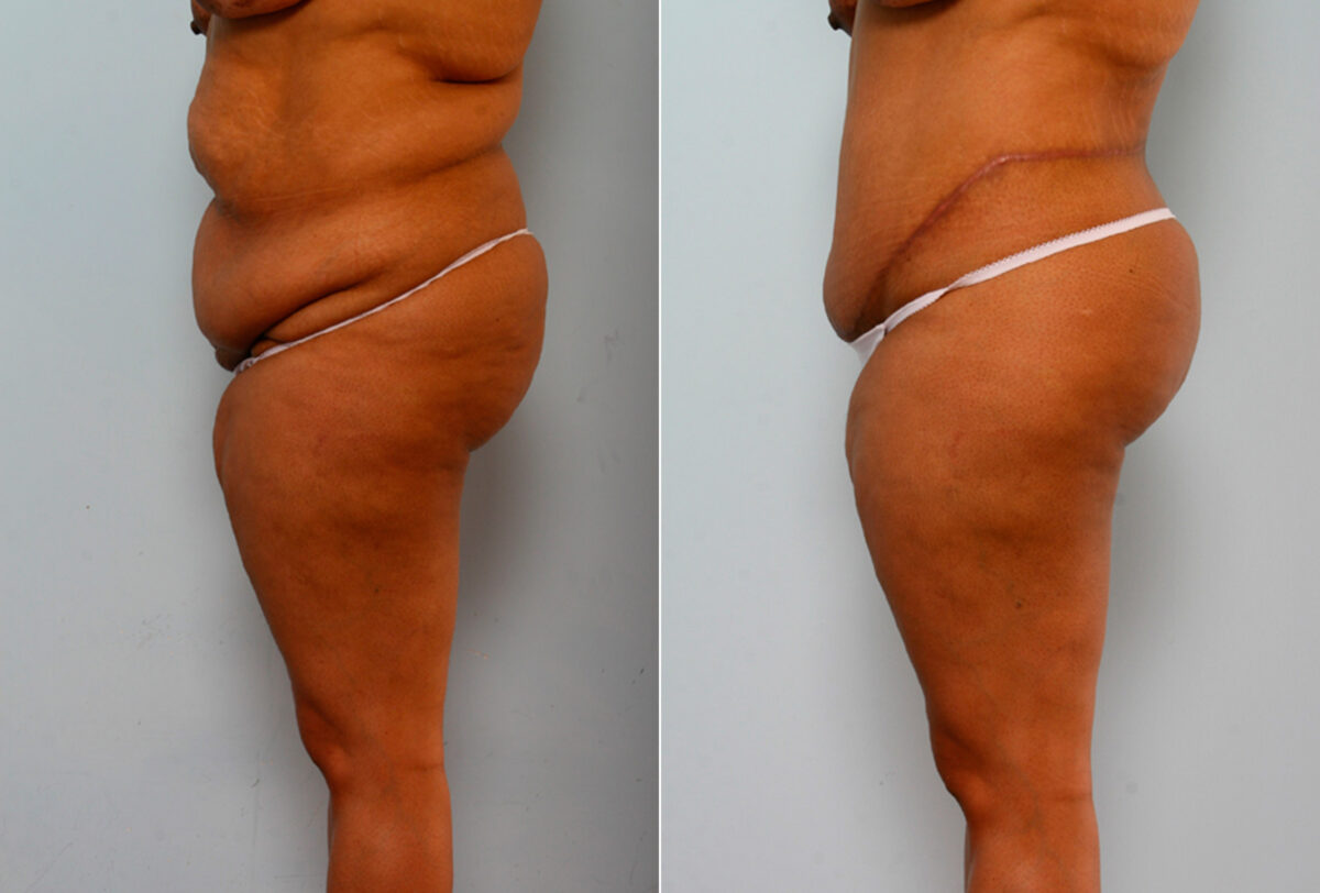 Body Lift before and after photos in Houston, TX, Patient 26773