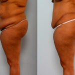 Body Lift before and after photos in Houston, TX, Patient 26773