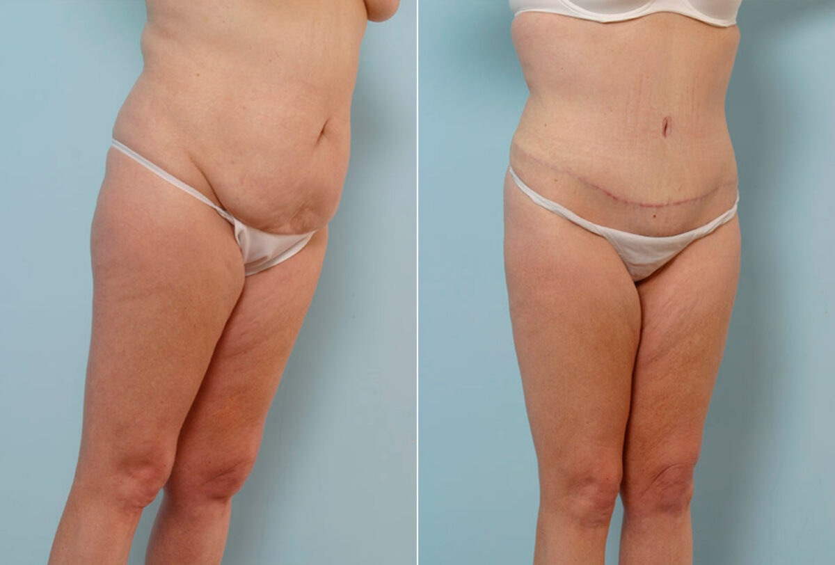 Tummy Tuck/Abdominoplasty before and after photos in Houston, TX, Patient 24457