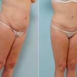 Abdominoplasty before and after photos in Houston, TX, Patient 24457