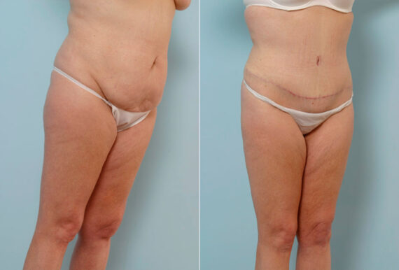 Tummy Tuck/Abdominoplasty before and after photos in Houston, TX, Patient 24457