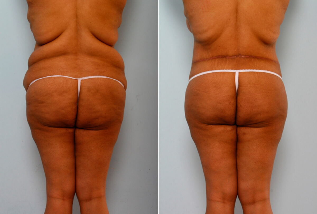 Body Lift before and after photos in Houston, TX, Patient 26773