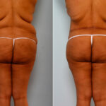 Body Lift before and after photos in Houston, TX, Patient 26773