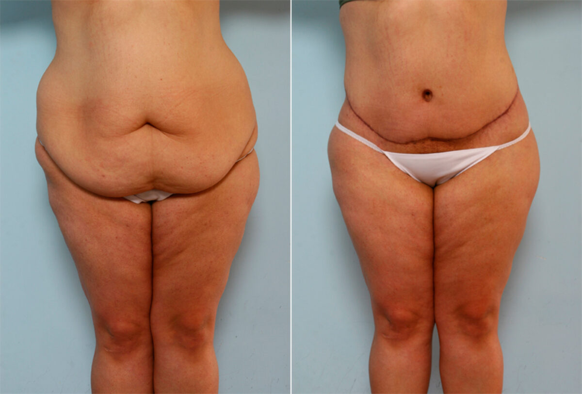 Body Lift before and after photos in Houston, TX, Patient 26786