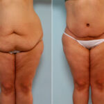 Body Lift before and after photos in Houston, TX, Patient 26786