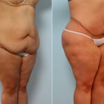 Body Lift before and after photos in Houston, TX, Patient 26786