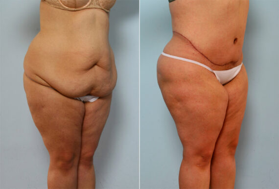 Body Lift before and after photos in Houston, TX, Patient 26786