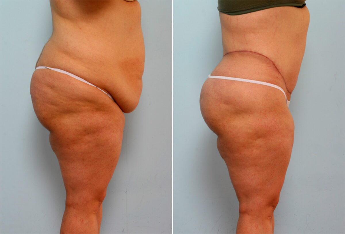 Body Lift before and after photos in Houston, TX, Patient 26786