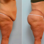 Body Lift before and after photos in Houston, TX, Patient 26786