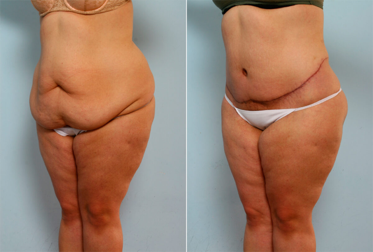 Body Lift before and after photos in Houston, TX, Patient 26786