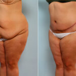 Body Lift before and after photos in Houston, TX, Patient 26786