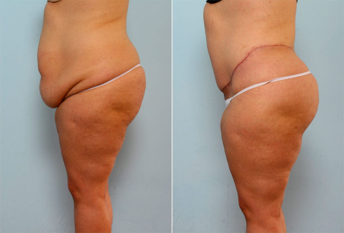 Body Lift before and after photos in Houston, TX, Patient 26786