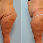 Body Lift before and after photos in Houston, TX, Patient 26786