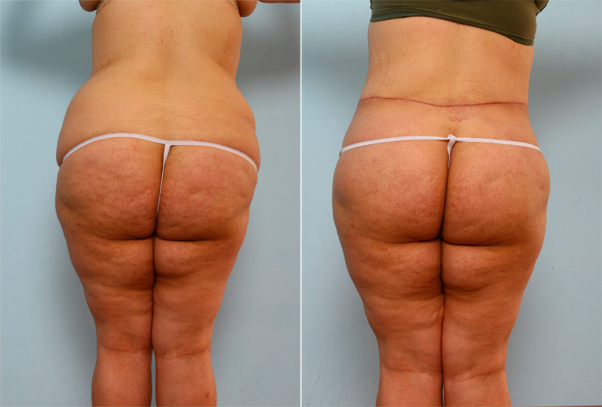 Body Lift before and after photos in Houston, TX, Patient 26786