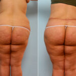 Body Lift before and after photos in Houston, TX, Patient 26786