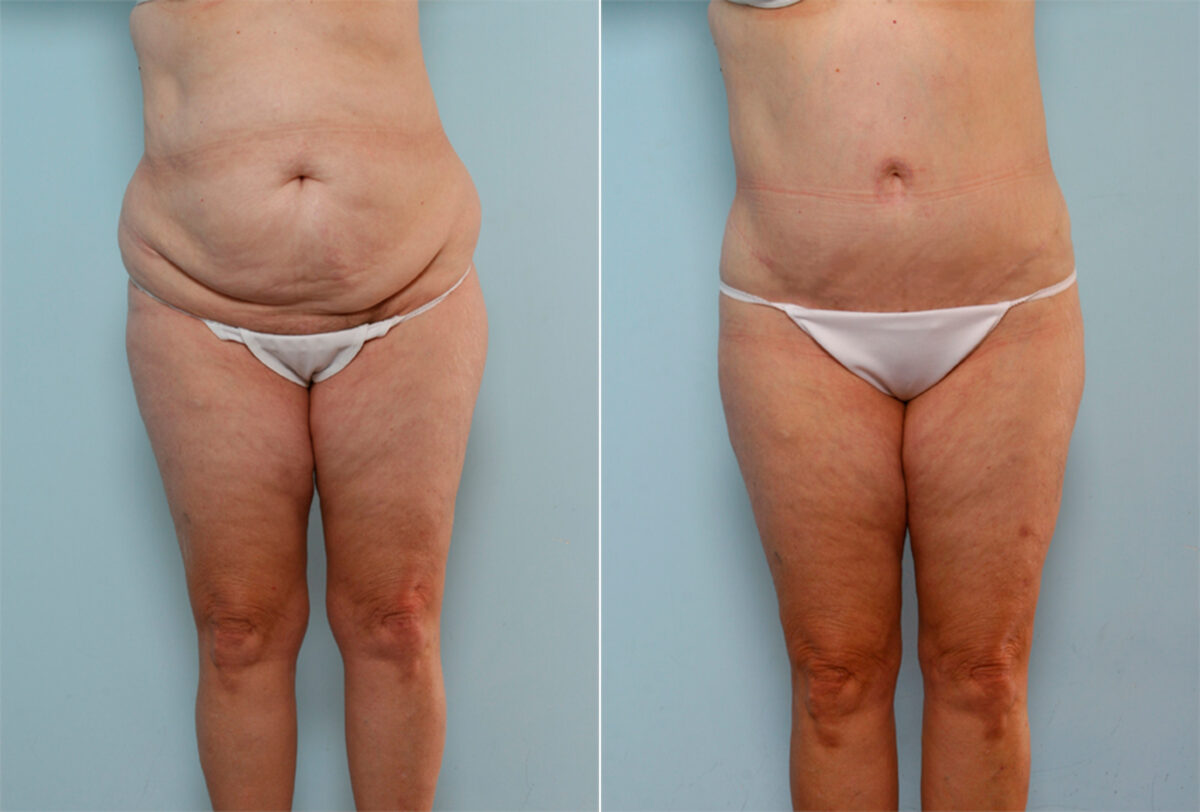 Body Lift before and after photos in Houston, TX, Patient 26799