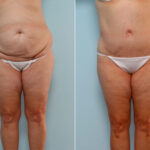 Body Lift before and after photos in Houston, TX, Patient 26799