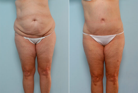 Body Lift before and after photos in Houston, TX, Patient 26799