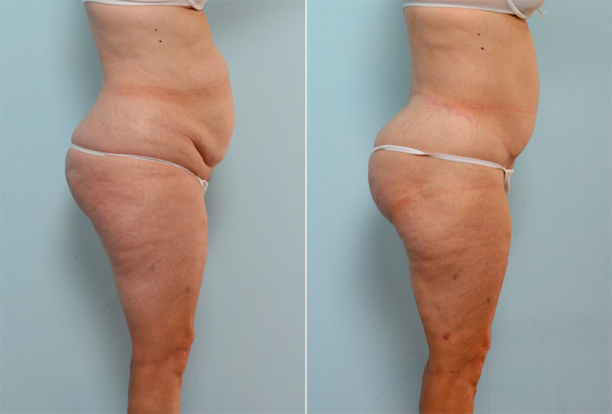 Body Lift before and after photos in Houston, TX, Patient 26799