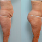 Body Lift before and after photos in Houston, TX, Patient 26799