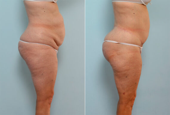 Body Lift before and after photos in Houston, TX, Patient 26799