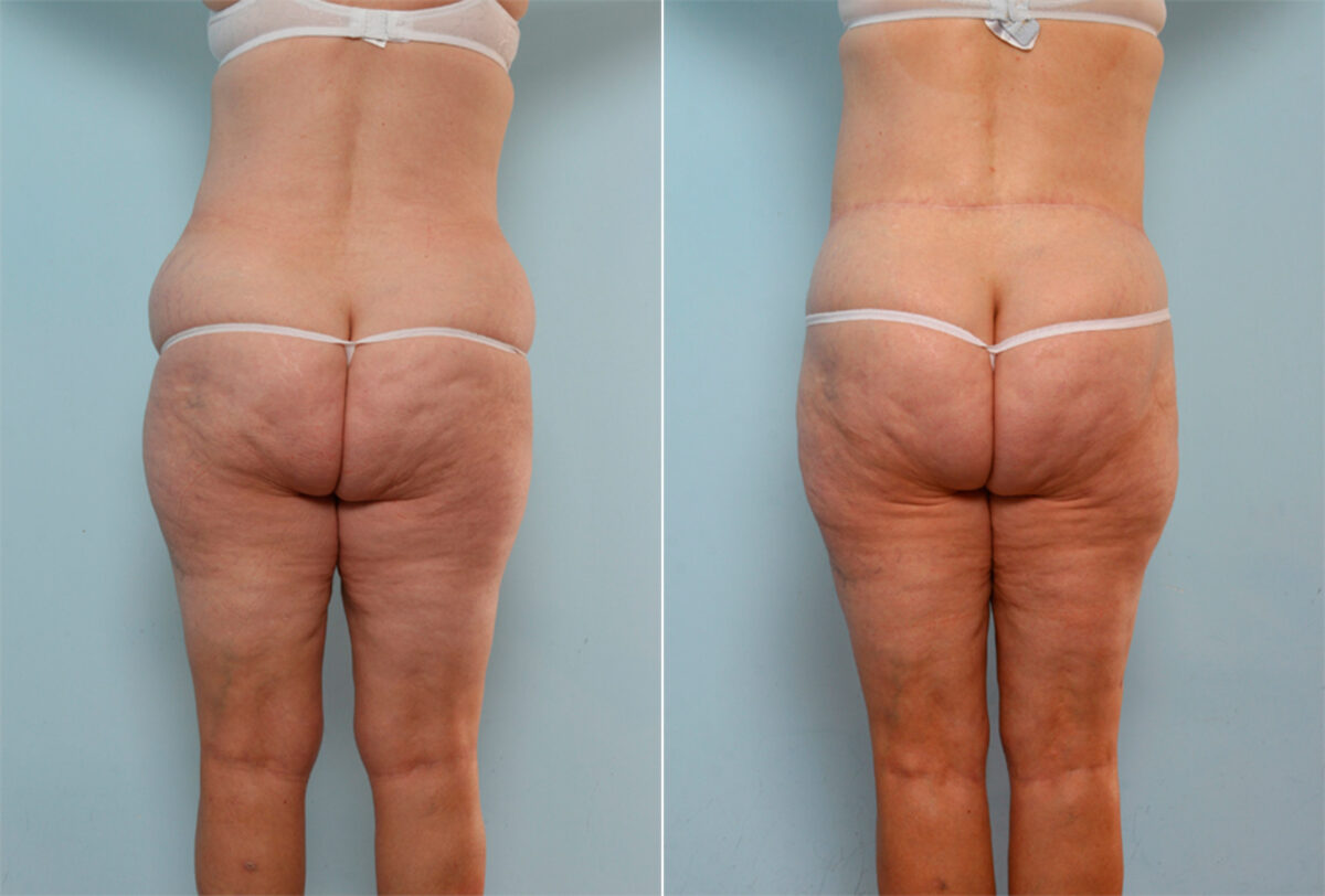 Body Lift before and after photos in Houston, TX, Patient 26799