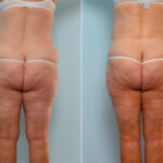 Body Lift before and after photos in Houston, TX, Patient 26799