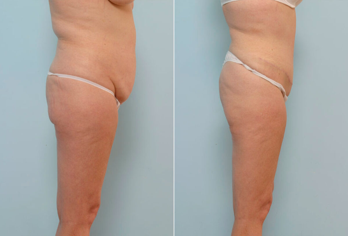 Abdominoplasty before and after photos in Houston, TX, Patient 24457