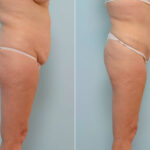 Abdominoplasty before and after photos in Houston, TX, Patient 24457