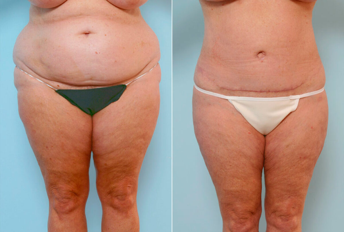 Body Lift before and after photos in Houston, TX, Patient 26815