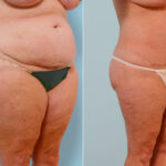 Body Lift before and after photos in Houston, TX, Patient 26815
