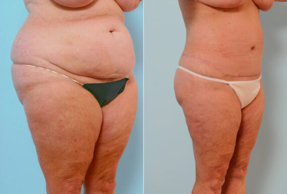 Body Lift before and after photos in Houston, TX, Patient 26815