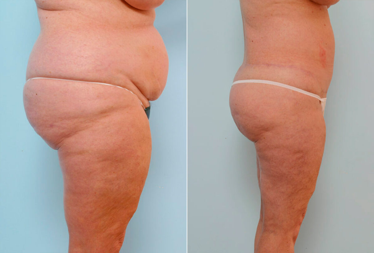 Body Lift before and after photos in Houston, TX, Patient 26815