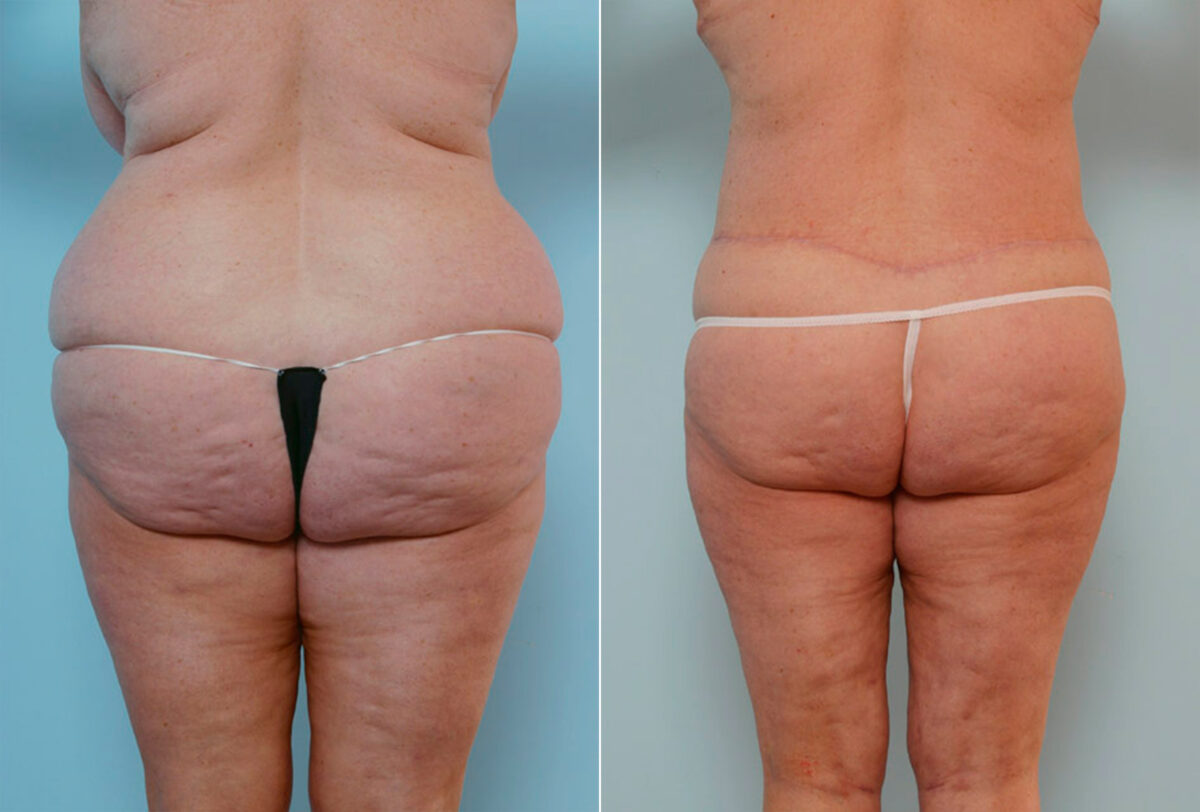 Body Lift before and after photos in Houston, TX, Patient 26815