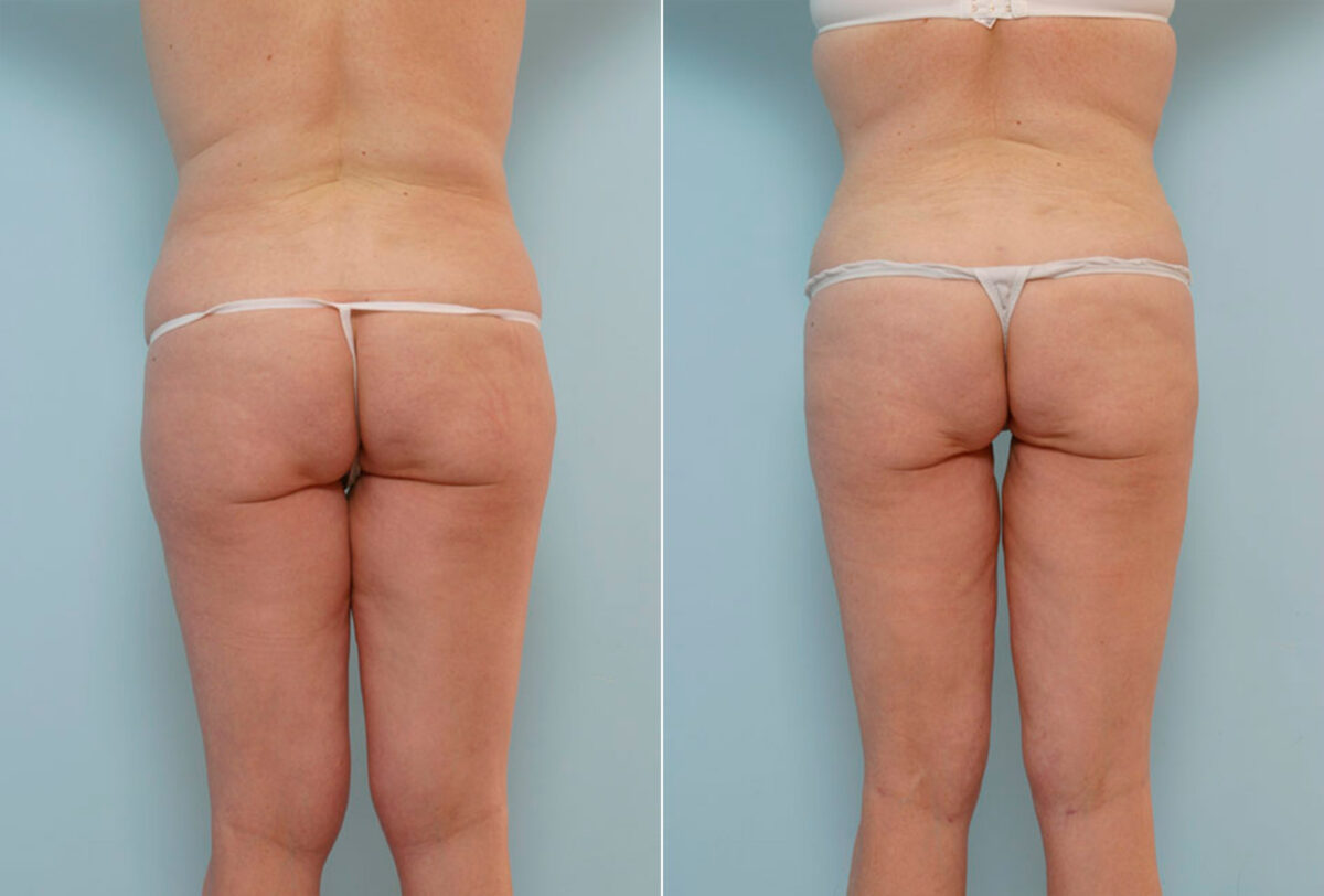 Abdominoplasty before and after photos in Houston, TX, Patient 24457