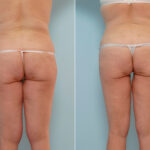 Abdominoplasty before and after photos in Houston, TX, Patient 24457