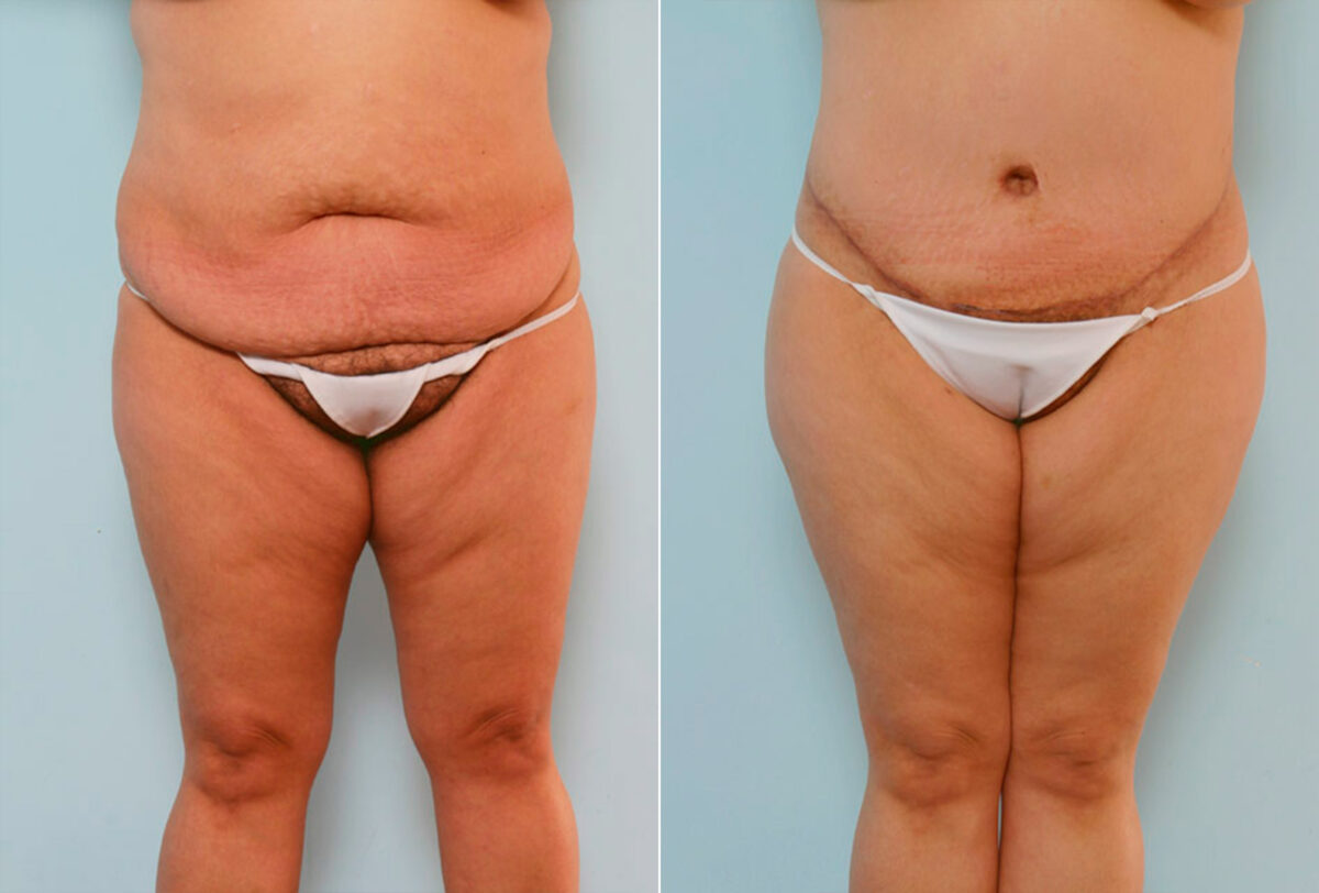 Body Lift before and after photos in Houston, TX, Patient 26842