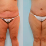 Body Lift before and after photos in Houston, TX, Patient 26842