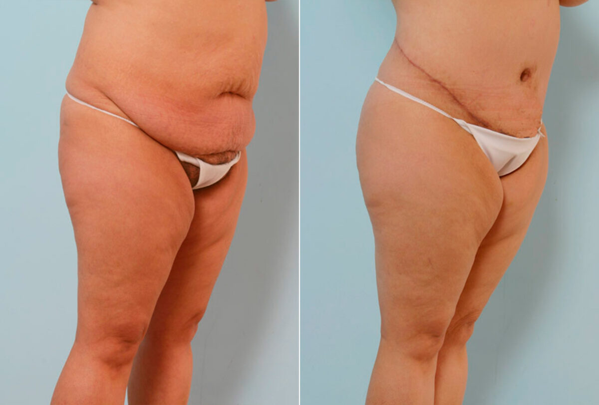 Body Lift before and after photos in Houston, TX, Patient 26842