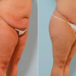 Body Lift before and after photos in Houston, TX, Patient 26842