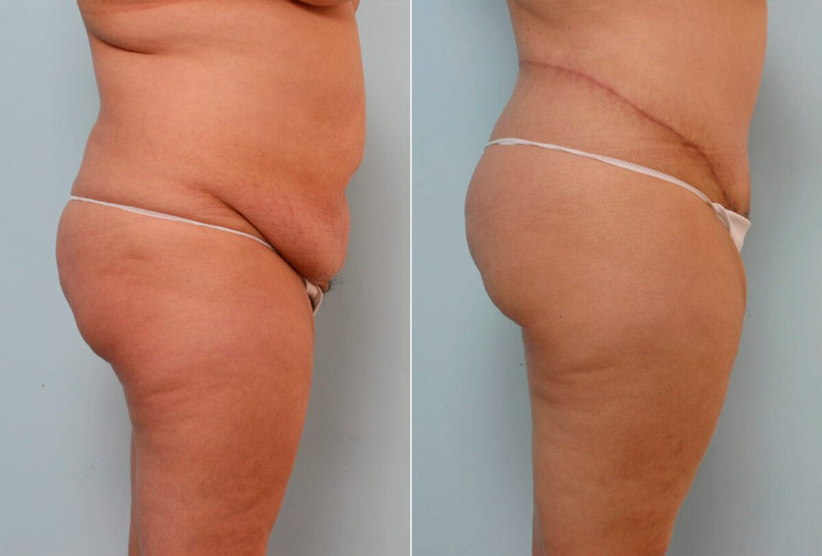 Body Lift before and after photos in Houston, TX, Patient 26842