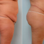 Body Lift before and after photos in Houston, TX, Patient 26842